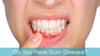 The Shocking Effects of Gum Disease and Your Health